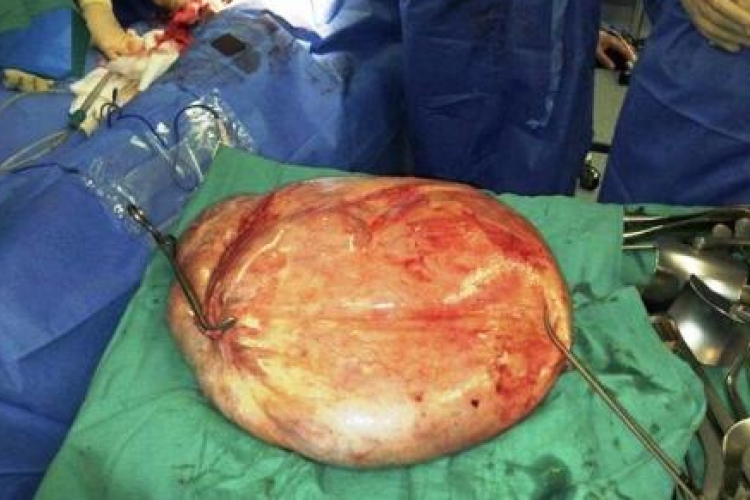 Huszonöt kilogrammos daganatot távolítottak el egy nő testéből